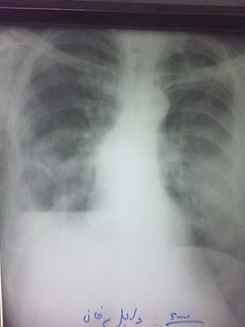 Lung Abcess