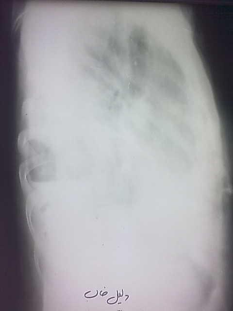 Lung Abcess