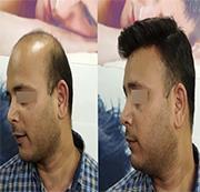 non surgical hair restoration