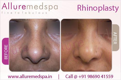 Nose Surgery (Rhinoplasty Surgery) in India