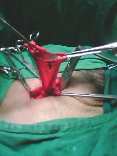 Opened Sac of Inguinal Hernia ( Final )