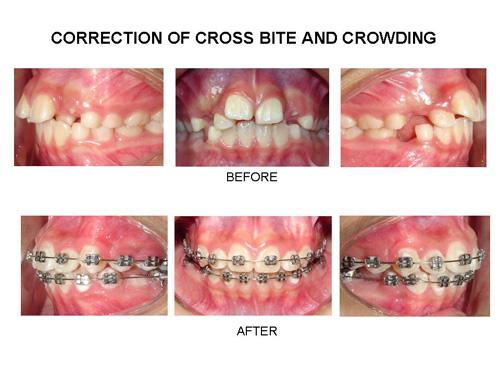 orthodontic treatment