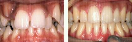 ORTHODONTIC TREATMENT In Nangal, Una himachal pradesh -32PEARLS IMPLANT & ORTHODONTIC DENTAL HOSPITAL SANTOKHGARH