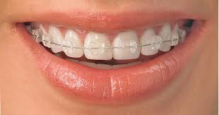 Orthodontics Treatment