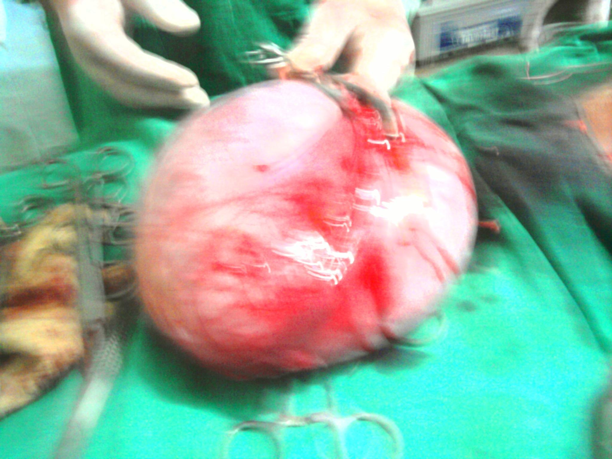 OVARIAN CYST