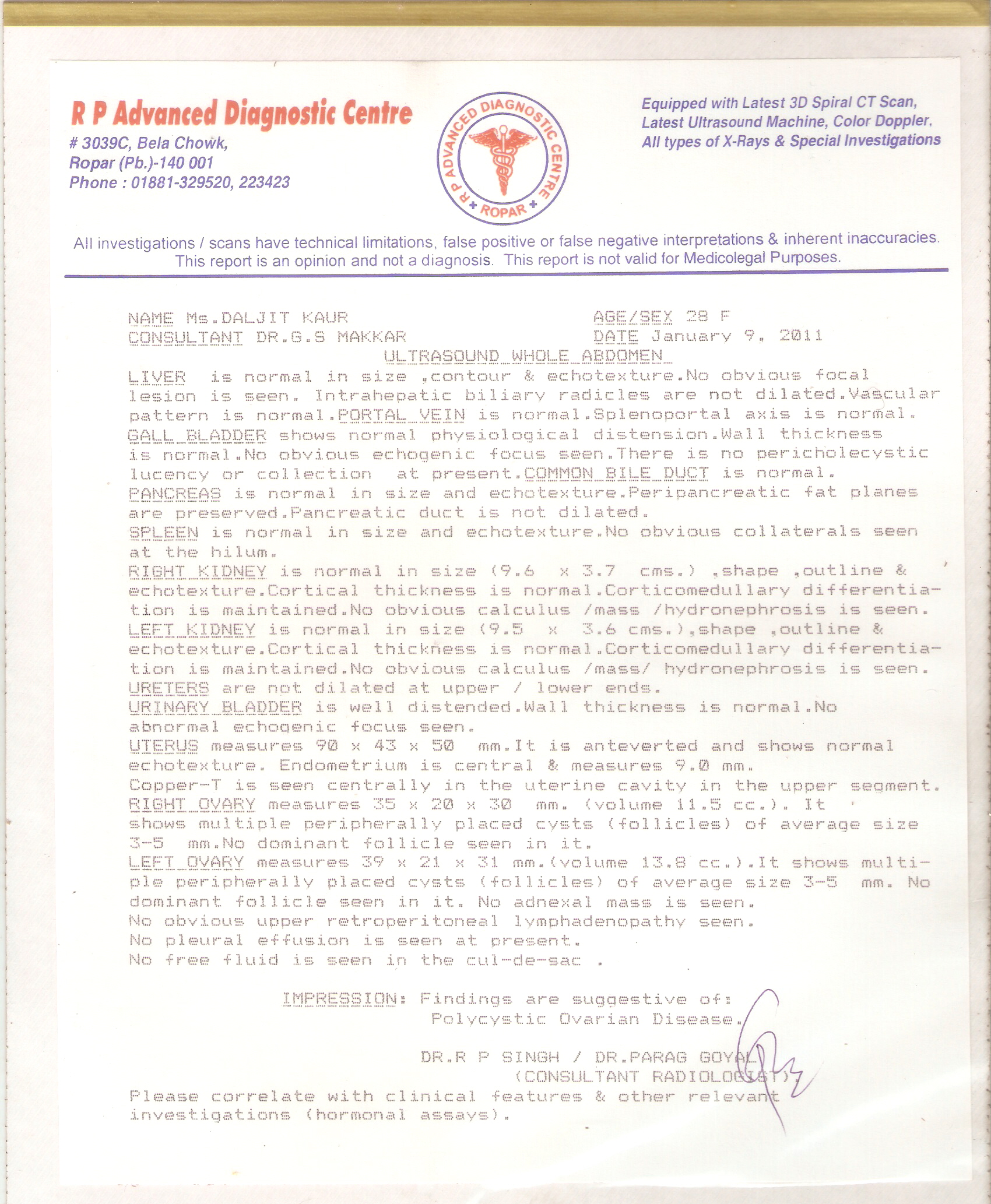 Ovarian cyst before treatment