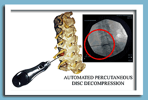 percutaneous discectomy