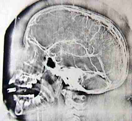 Photostat copy of neuroangiography developed by me while working at AIIMS, New Delhi. 