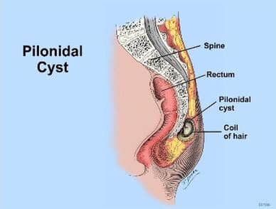 Pilonidal Laser Ablation - Pilonidal Treatment Center of New Jersey