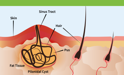 Pilonidal Treatments - Pilonidal Treatment Center of New Jersey