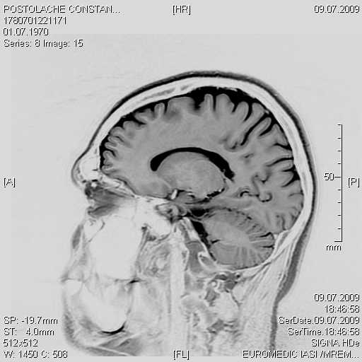 Pituitary adenoma ???