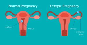 Pregnancy outside the Uterus