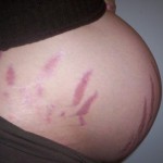 Pregnancy Scars