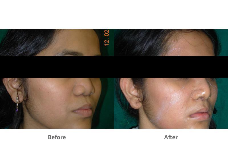 Rhinoplasty