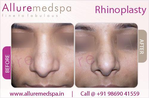 Rhinoplasty Before After