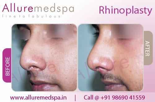 Rhinoplasty Before and After Photos Rhinoplasty Before and After