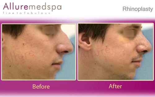 Rhinoplasty Mumbai