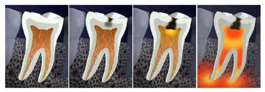 Root Canal Treatment