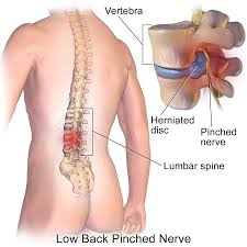 slipped disc treatment in Jacksonville Florida