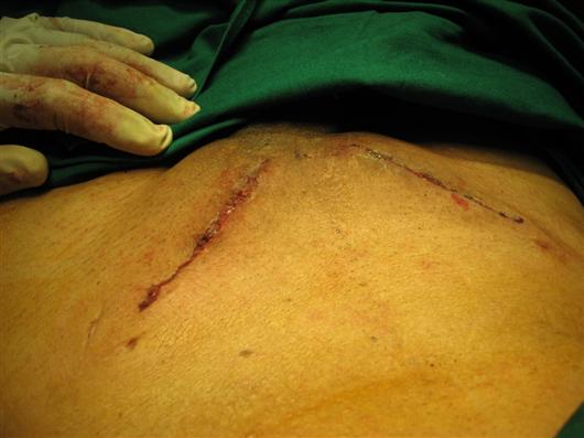 Stitch Less Inguinal Hernia Surgery