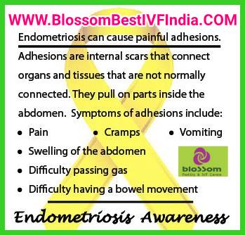 Symptoms of Endometriosis