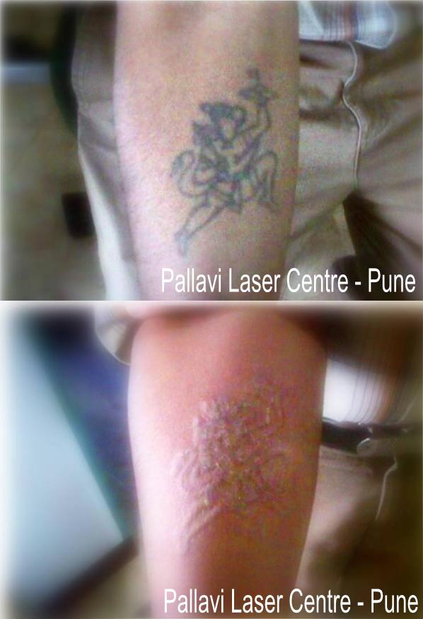 Tattoo Removal