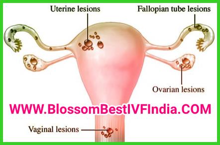 Treatment of Endometriosis