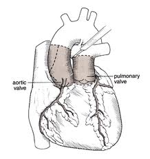 Valve Replacement Surgery in India