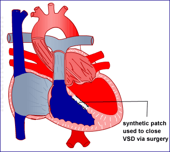 Ventricular Septal Defect Surgery Benefits India