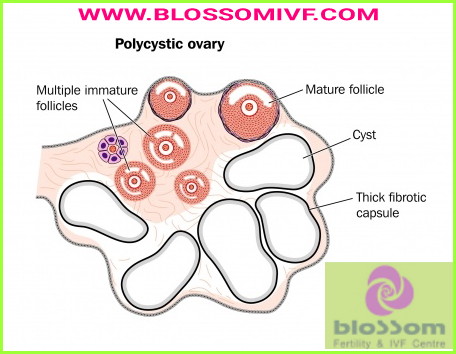 What is PCOS?