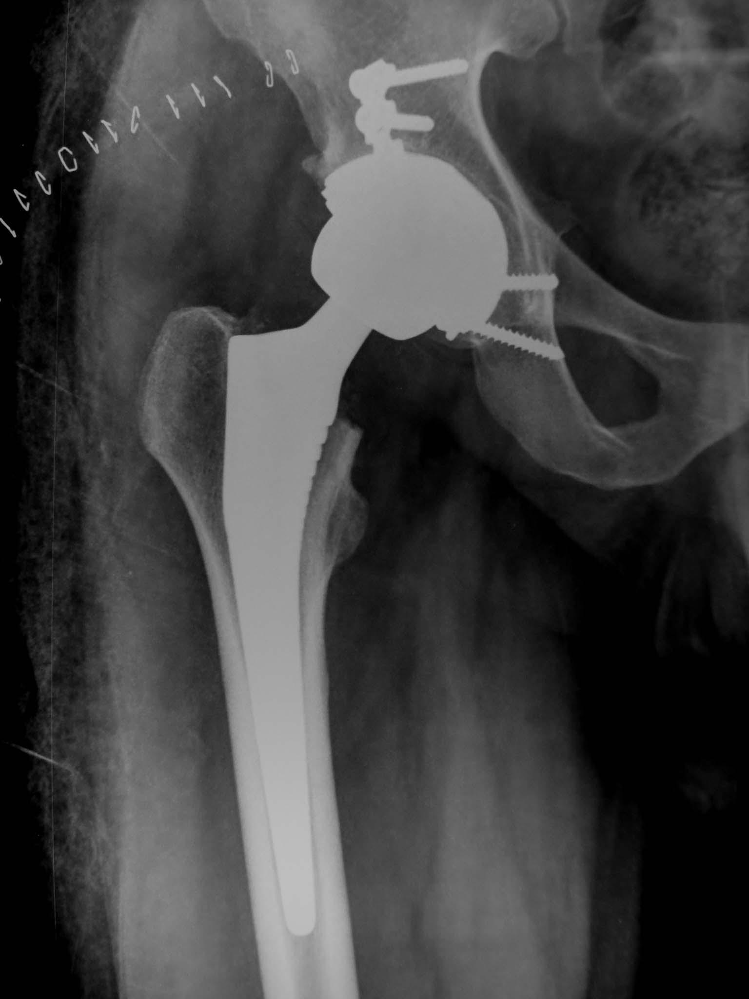 Young Male- Post Trauma Avn